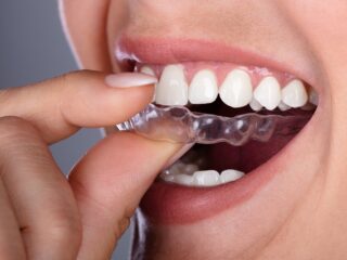 How Long Does It Take For Clear Aligners To Work?