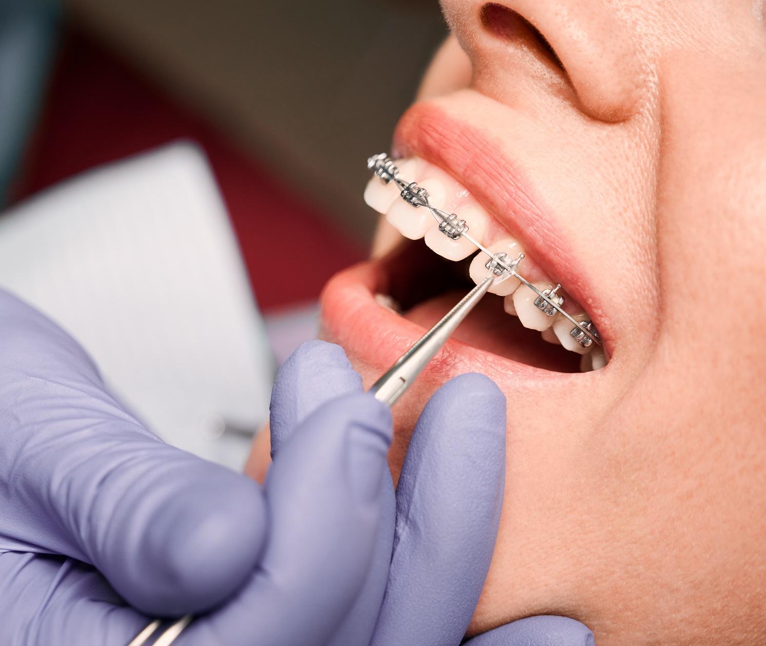 dental braces
